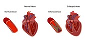 Atherosclerosis and enlarged heart, illustration