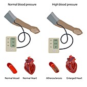 Hypertensive heart disease, illustration