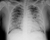 Covid-19 pneumonia, X-ray