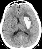 Intracerebral haemorrhage, CT scan