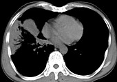 Lung cancer, CT scan