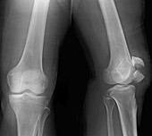 Broken knee cap, X-ray