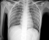 Miliary tuberculosis, X-ray