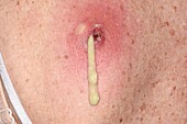 Draining of a sebaceous cyst