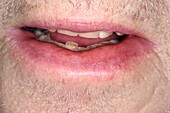 Swollen lip due to ciprofloxacin antibiotic