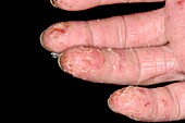 Dermatitis