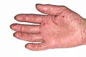 Dermatitis