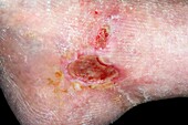 Leg ulcers in chronic venous insufficiency
