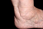 Swelling ankle