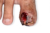 Overgranulation in ingrowing toenail