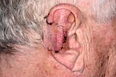 Wound after surgery to remove basal cell carcinoma