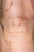 Wound on the back of upper calf