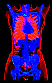 Rib cage and pelvis, 3D CT scan
