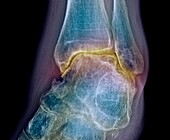 Ankle osteoarthritis, X-ray