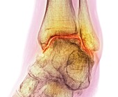 Ankle osteoarthritis, X-ray