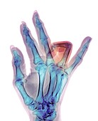 Dupuytren's contracture, X-ray