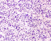 Chronic myeloid leukaemia, light micrograph