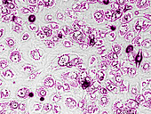 Fibroblasts with enlarged lysosomes, light micrograph