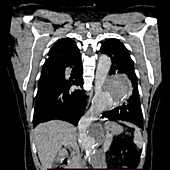 Saccular aortic aneurysm, CT scan