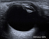 Cataract, ocular ultrasound