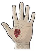 Bullet exit wound on palm of hand, illustration