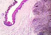 Familial malignant melanoma, light micrograph