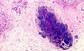 Familial pancreatic cancer, light micrograph