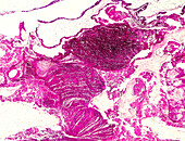Gestational trophoblastic disease, light micrograph