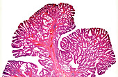 Hereditary mixed polyposis syndrome, light micrograph