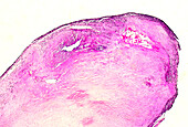 Infectious myocarditis, light micrograph