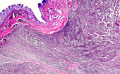 Paediatric neuroblastoma, light micrograph