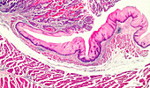 Oral and oropharyngeal cancer, light micrograph