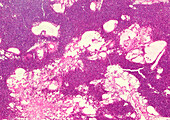 Retiform haemangioendothelioma, light micrograph