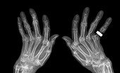 Rheumatoid arthritis, X-ray
