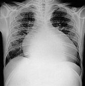 Cardiomyopathy, chest X-ray