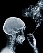 Person smoking a cigarette, X-ray