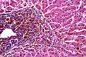 Abnormal liver cells, light micrograph