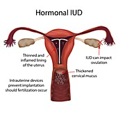 Hormonal IUD, illustration