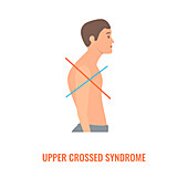 Upper crossed syndrome, conceptual illustration