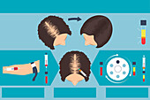 Platelet rich plasma female alopecia treatment, illustration