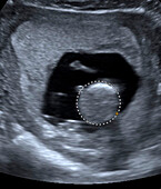 Foetal measurement, ultrasound scan