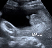 30 week old male foetus, ultrasound scan