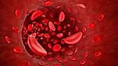 Sickle cell anaemia, illustration