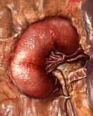 Kidney Disease Progression, 2 of 3