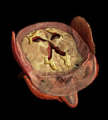 Ventricular Dilation, Male Brain