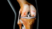 Knee with Arthritis, 3 of 4