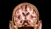 Coronal Section of Brain, Alzheimer's Disease