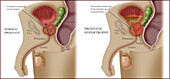 Prostate Hypertrophy, Illustration