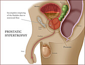 Prostatic Hypertrophy, Illustration