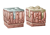 Sinusitis, Illustration